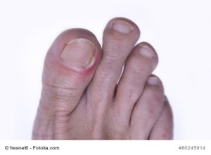 inflamed toenail