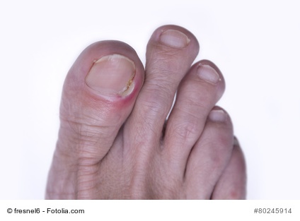 Toenail Removal Painful, Or Not? My Experience - Fitness Oriented