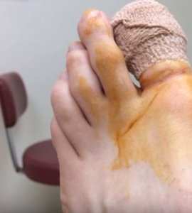 Is toenail removal painful